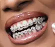 Teeth Grillz Braces - 1
