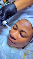 Anti Acne Facial Treatment - 2