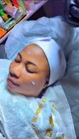 Anti Acne Facial Treatment - 4