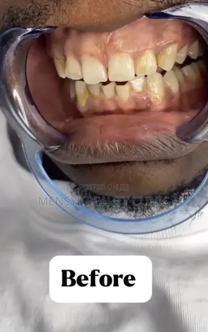 Professional Teeth Whitening Service