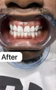 Professional Teeth Whitening Service - 2
