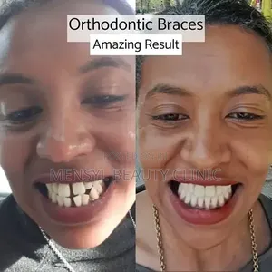 Professional Dental Braces for Teeth Alignment
