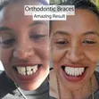 Professional Dental Braces for Teeth Alignment - 1