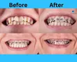 Professional Dental Braces for Teeth Alignment - 2