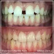 Professional Dental Braces for Teeth Alignment - 3
