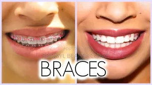 Fashion Braces Available - Mensyl Beauty Clinic