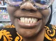 Fashion Braces Available - Mensyl Beauty Clinic - 2