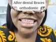 Fashion Braces Available - Mensyl Beauty Clinic - 3
