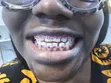 Fashion Braces Available - Mensyl Beauty Clinic - 4