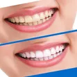 Instant Teeth Whitening Strips - 2