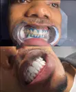 Teeth Whitening Service - 2