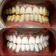 Teeth Whitening Service - 3