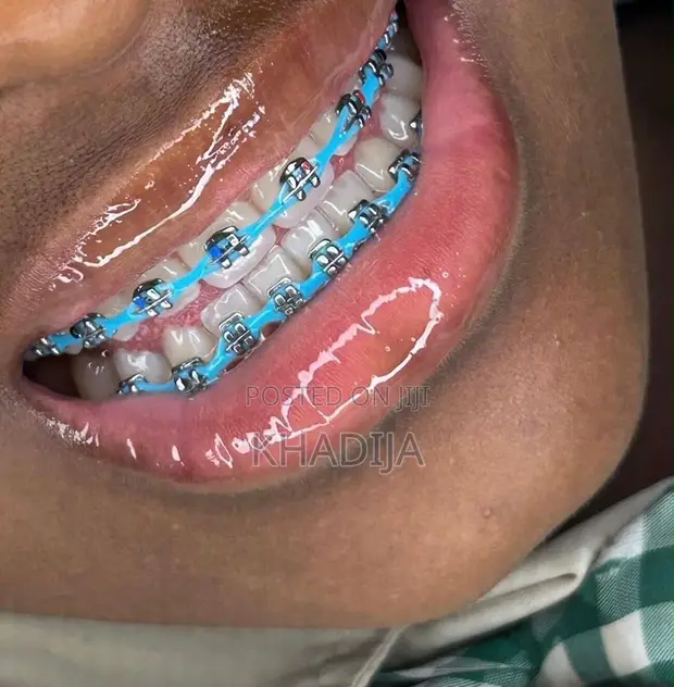 Fashion Braces - 1