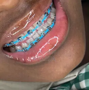 Fashion Braces